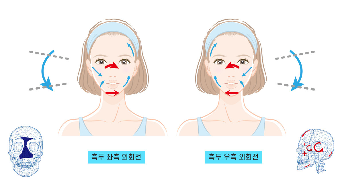 Category 2 안면비대칭