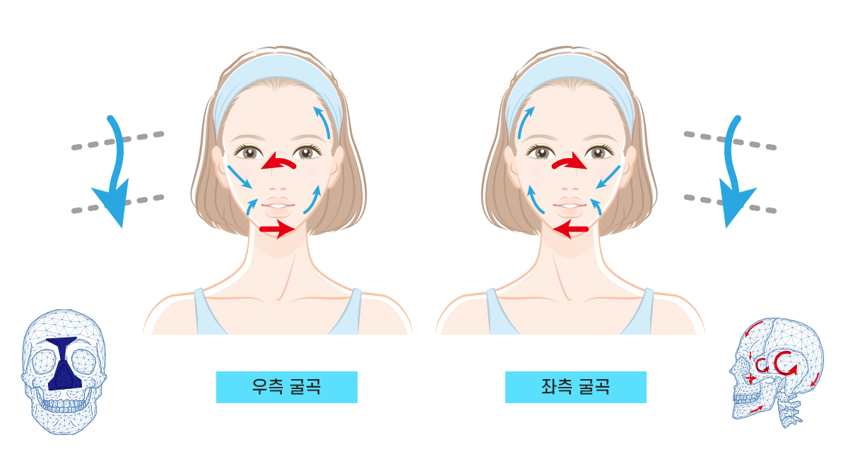 Category 3 안면비대칭