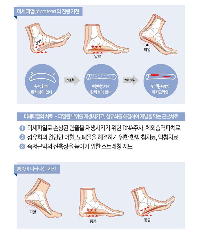 족저근막 미세파열 진행 기전 도식